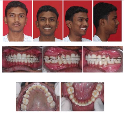 Second Premolar Extraction: A Case Report – Biomedical and Pharmacology ...