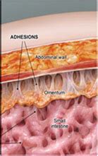 Abdominal Adhesions and Laparoscopic Adhesiolysis, Mumbai, India