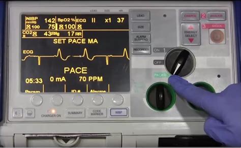 Transcutaneous Pacing — Down East Emergency Medicine