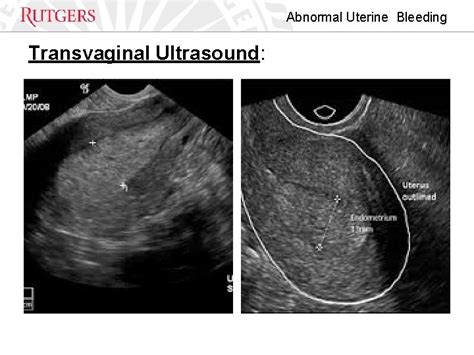 Abnormal Uterine Bleeding in Reproductive Age Women Charletta