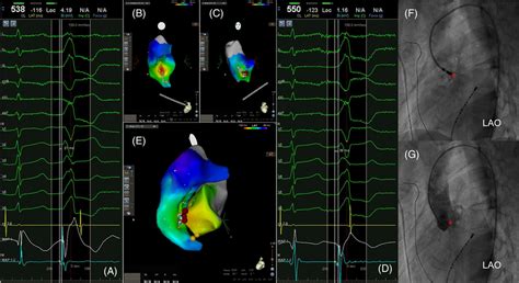 Example of mapping PVC origin and confirming successful ablation site.... | Download Scientific ...