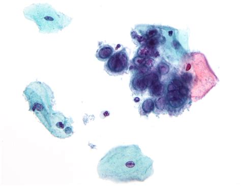 File:Herpes simplex virus pap test.jpg - Wikipedia