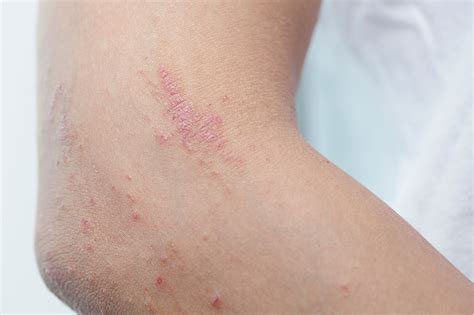 Most Common Skin Lesions - Valley County Health System