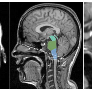 (PDF) Improving Accuracy of Brainstem MRI Volumetry: Effects of Age and Sex, and Normalization ...