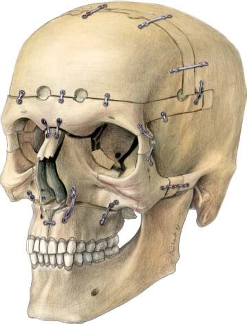 Craniofacial Surgery | Plastic Surgery Key