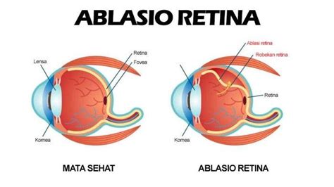 Waspada Retina Mata Lepas yang Beresiko Mengalami Kebutaan Permanen - TribunHealth.com