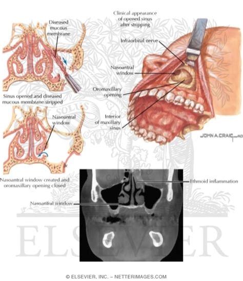 Surgical Procedures: Caldwell-Luc Procedure