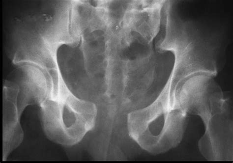 Pelvic Fracture X Ray