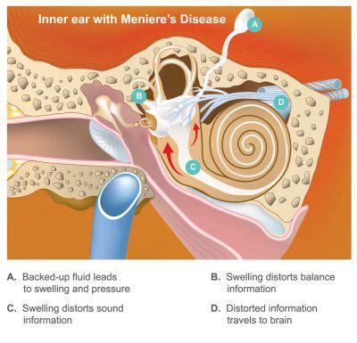 Meniere's Disease - Symptoms, Causes, Treatments