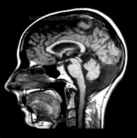 Mega Cisterna Magna on MRI | Stock Image - Science Source Images