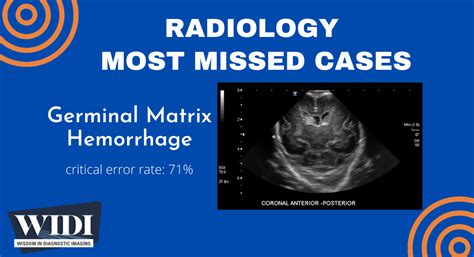 Most Missed Case: Germinal Matrix Hemorrhage » Wisdom in Diagnostic Imaging » College of ...