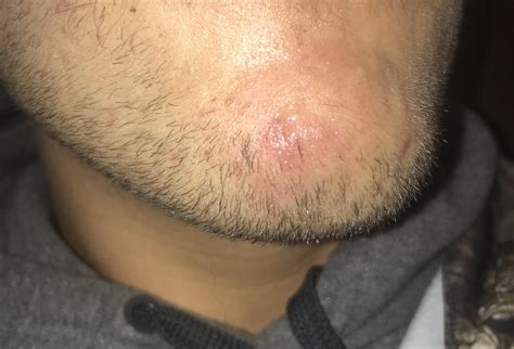 Boil on chin help! : r/acne