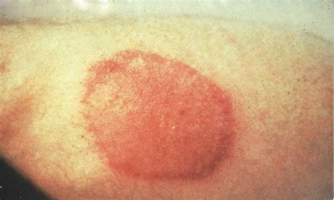 Lyme Disease « Disease Images « CFSPH