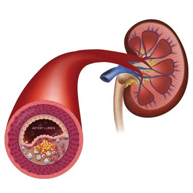 Renal Artery Stenosis | Risk Factors, Causes, Symptoms, Diagnosis, Treatment