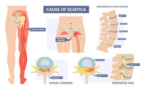 When Surgery Is Needed For Sciatica | New Jersey | Comprehensive Spine Care