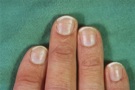 nail bed ridges | Horizontal ridges on fingernails, Nail ridges ...