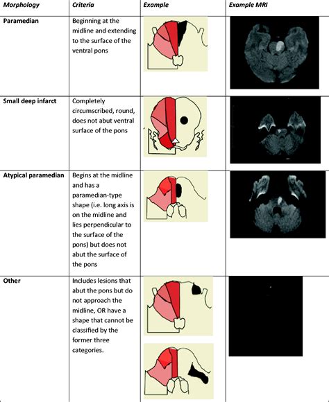 Paramedian Pontine Infarct