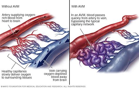 AVM blood flow - Mayo Clinic