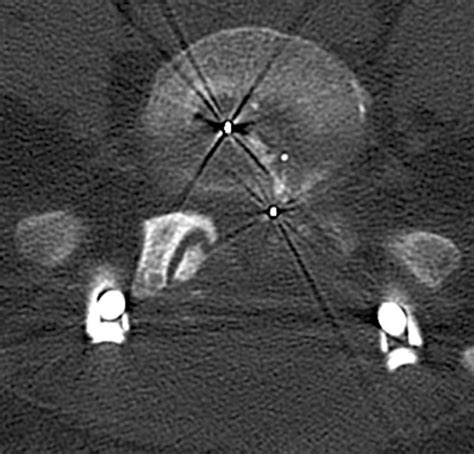 Set screw fracture with cage dislocation after two-level transforaminal lumbar interbody fusion ...