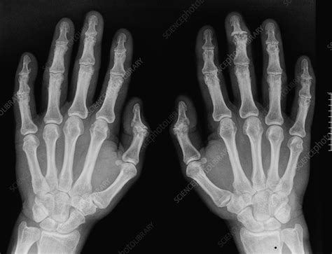 Osteoarthritis in the hands, X-ray - Stock Image C016/8214 - Science Photo Library