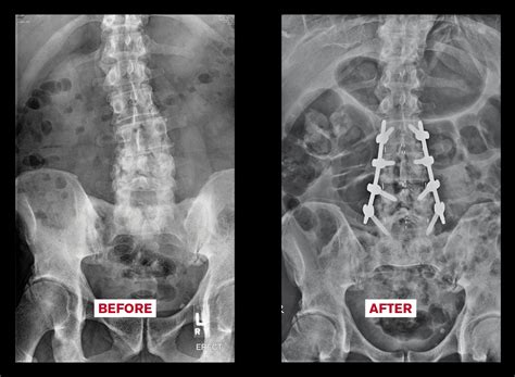 From Florida to Bangkok for OLIF Spine Surgery (Poolside Interview) - Spine Connection