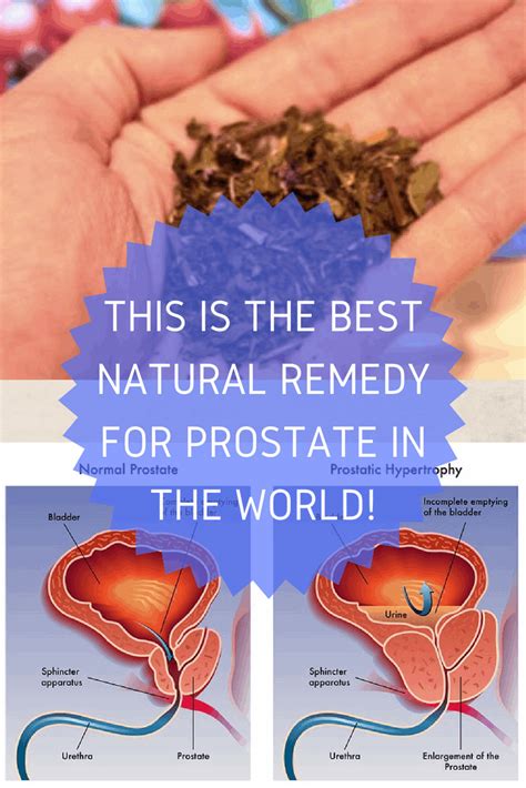 THIS IS THE BEST NATURAL REMEDY FOR PROSTATE IN THE WORLD! | Prostate