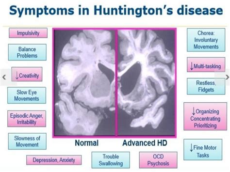 STAGES of HUNTINGTON’SSTAGES of HUNTINGTON’S DISEASEDISEASE There are five stage of HD 1. Precli ...