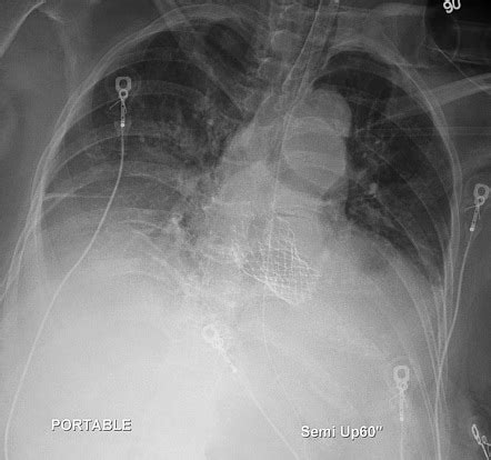 Transcatheter aortic valve implantation (TAVI) | Radiology Reference Article | Radiopaedia.org