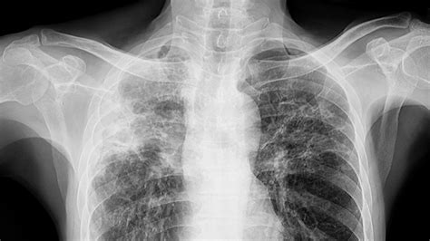 IMMIGRATION X-RAY FOR TUBERCULOSIS - Mayfair Diagnostics