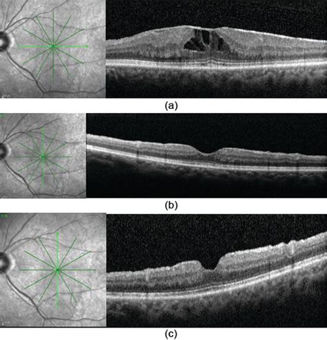 Clinical Use of OCT in the Management of Epiretinal Membranes | IntechOpen