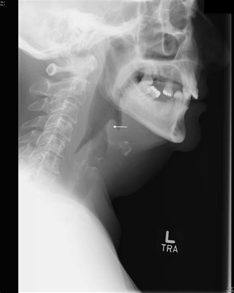 Cureus | Back to Basics: A Case of Adult Epiglottitis