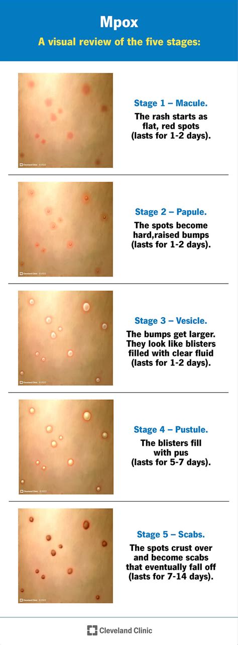 Mpox (Monkeypox): Causes, Symptoms, Treatment & Prevention