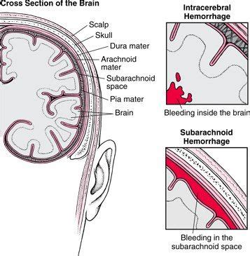 Hess And Hunt Scale Is Most Widely Used To Grade The Severity Of Subarachnoid Hemorrhage ...