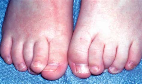 Brittle Toenails & Fingernails Signs, Causes,Treatment-Thyroid, Vitamin ...