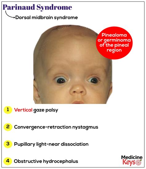 Parinaud syndrome - Medicine Keys for MRCPs