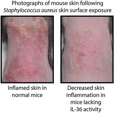 How the skin becomes inflamed