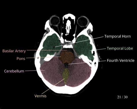 View 14 Brain Anatomy Labeled Ct - birlaswasumy