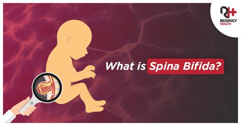 Spina Bifida: Causes, Symptoms, Types, Diagnosis and Treatment