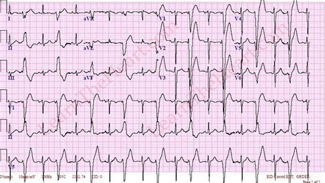 Ventricular Bigeminy ECG Example 2 | LearntheHeart.com