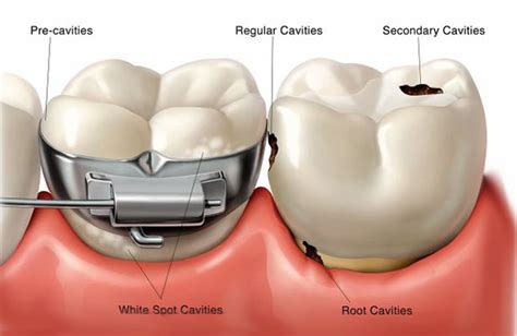 Dental Filling - Broken Fillings, Cavity Treatment, Tooth Decay