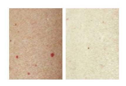 Chicago Laser Removal: Red Moles ./ Cherry Angiomas & Spider Angiomas