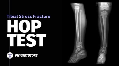 Hop Test | Tibial Stress Fractures - YouTube