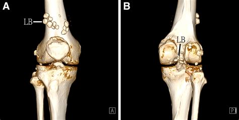 Arthroscopic Synovectomy and Removal of Loose Bodies in Synovial Osteochondromatosis of the Knee ...