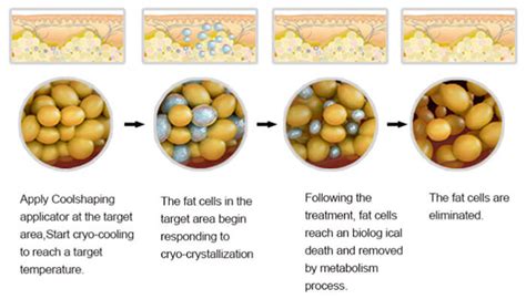 News - What Is Cryolipolysis?