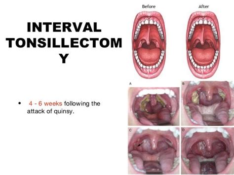 QUINSY (Peritonsillar Abscess)