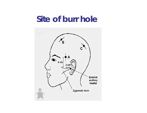 Burr Hole