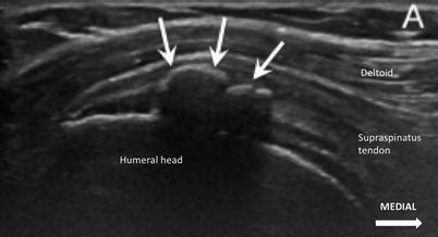 Calcific Tendinitis | Anesthesia Key