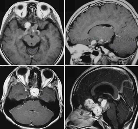 Optic glioma is classified roughly in a) optic nerve (anterior type)... | Download Scientific ...