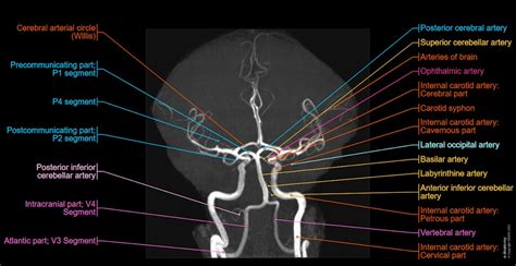 Time-of-Flight (TOF) MR Angiography of the brain