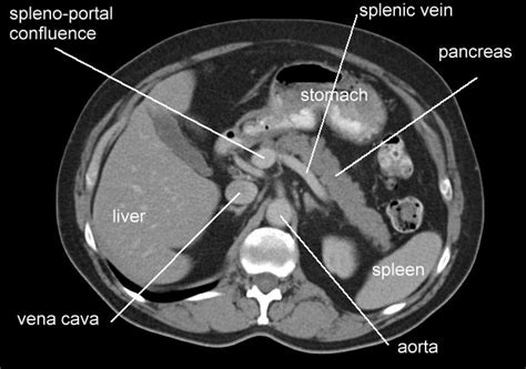 CT Scan Tips & Protocols: CT anatomy of pancreatic level